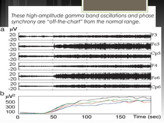 These high-amplitude gamma band oscillations and phase 
synchrony are “off-the-chart” from the normal range. 
 