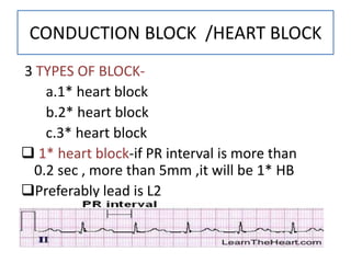 Easy ECG INTERPRETATION | PPTX