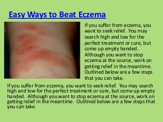 Easy Ways to Beat Eczema
                                   If you suffer from eczema, you
                                   want to seek relief. You may
                                   search high and low for the
                                   perfect treatment or cure, but
                                   come up empty handed.
                                   Although you want to stop
                                   eczema at the source, work on
                                   getting relief in the meantime.
                                   Outlined below are a few steps
                                   that you can take.
If you suffer from eczema, you want to seek relief. You may search
high and low for the perfect treatment or cure, but come up empty
handed. Although you want to stop eczema at the source, work on
getting relief in the meantime. Outlined below are a few steps that
you can take.
 