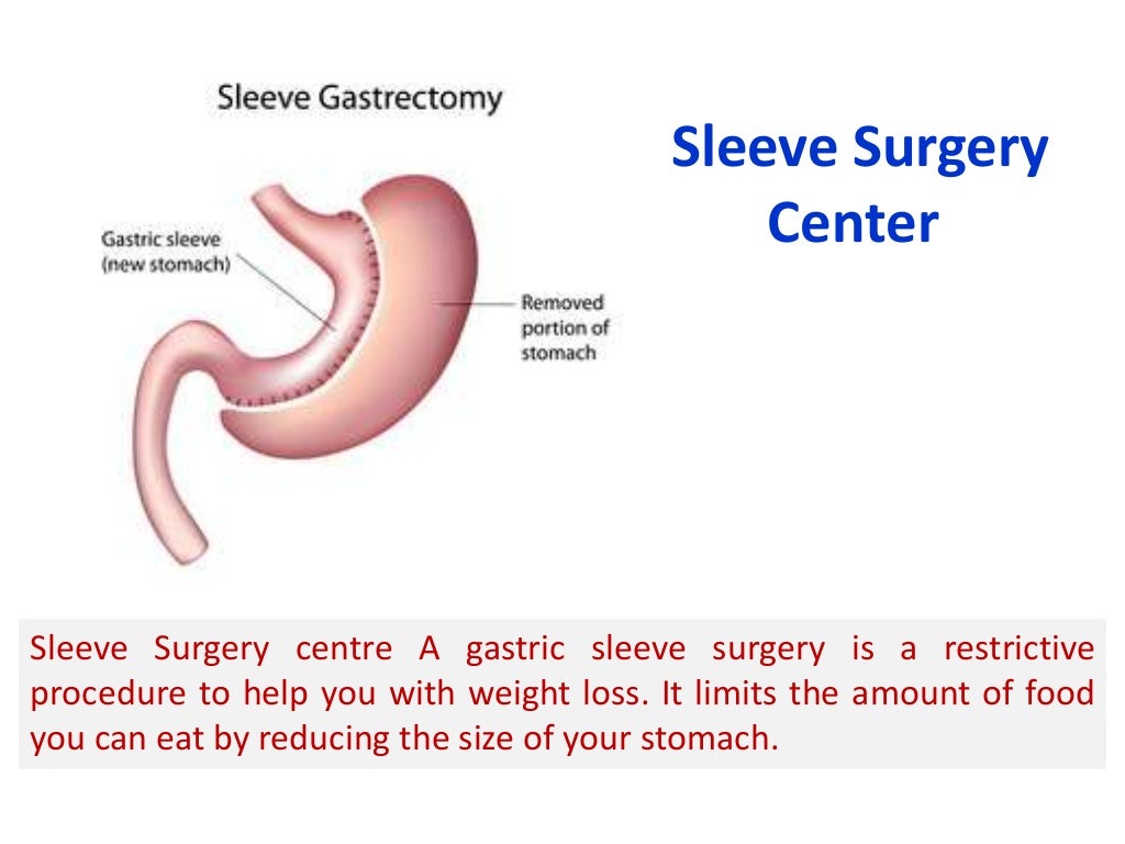 Sleeve Surgery Center