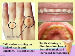 EATING DISORDER.pptx