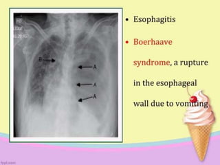 EATING DISORDER.pptx