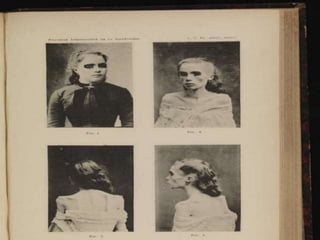 EATING DISORDER.pptx