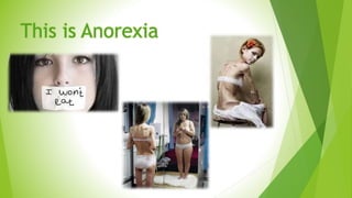 This is Anorexia
 