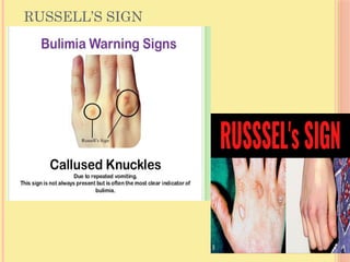 RUSSELL’S SIGN
 