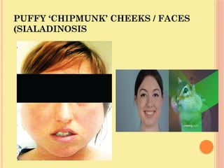 PUFFY ‘CHIPMUNK’ CHEEKS / FACES
(SIALADINOSIS
 