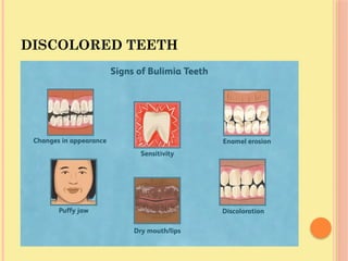 DISCOLORED TEETH
 