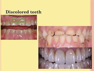 Discolored teeth
 