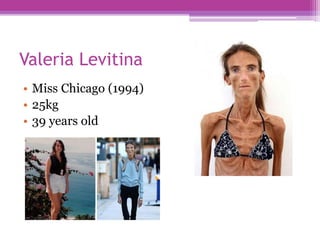 Eating disorders | PPT