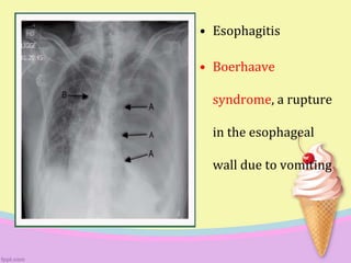 • Esophagitis
• Boerhaave
syndrome, a rupture
in the esophageal
wall due to vomiting
 