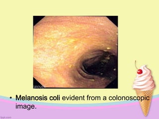 • Melanosis coli evident from a colonoscopic
image.
 