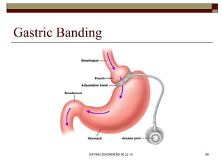 Gastric Banding




            EATING DISORDERS 06 22 10   95
 