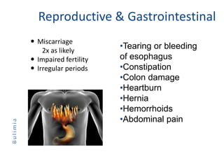Reproductive & Gastrointestinal
 Miscarriage
2x as likely
 Impaired fertility
 Irregular periods
•Tearing or bleeding
of esophagus
•Constipation
•Colon damage
•Heartburn
•Hernia
•Hemorrhoids
•Abdominal pain
 
