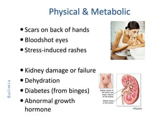 Physical & Metabolic
Scars on back of hands
Bloodshot eyes
Stress-induced rashes
Kidney damage or failure
Dehydration
Diabetes (from binges)
Abnormal growth
hormone
 