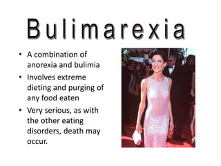 • A combination of
anorexia and bulimia
• Involves extreme
dieting and purging of
any food eaten
• Very serious, as with
the other eating
disorders, death may
occur.
 