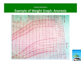 Eating Disorders
Example of Weight Graph: Anorexia
 