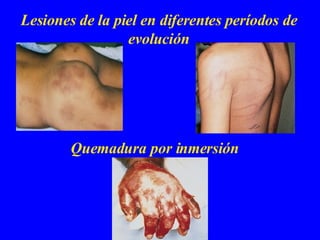 Lesiones de la piel en diferentes períodos de evolución Quemadura por inmersión 