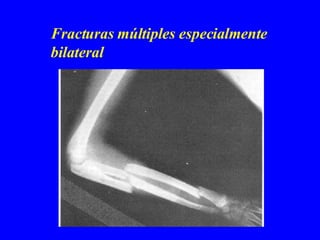 Fracturas múltiples especialmente bilateral 