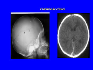 Fractura de cráneo 