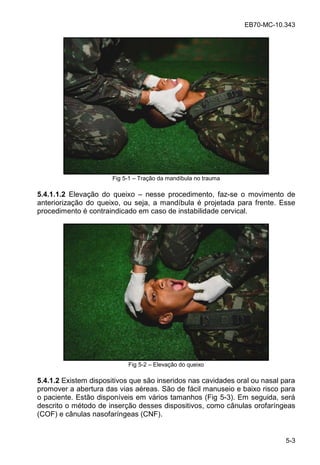 EB70-MC-10.343
5-3
Fig 5-1 Tração da mandíbula no trauma
5.4.1.1.2 Elevação do queixo nesse procedimento, faz-se o movimento de
anteriorização do queixo, ou seja, a mandíbula é projetada para frente. Esse
procedimento é contraindicado em caso de instabilidade cervical.
Fig 5-2 Elevação do queixo
5.4.1.2 Existem dispositivos que são inseridos nas cavidades oral ou nasal para
promover a abertura das vias aéreas. São de fácil manuseio e baixo risco para
o paciente. Estão disponíveis em vários tamanhos (Fig 5-3). Em seguida, será
descrito o método de inserção desses dispositivos, como cânulas orofaríngeas
(COF) e cânulas nasofaríngeas (CNF).
 