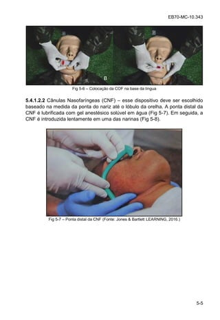 EB70-MC-10.343
5-5
Fig 5-6 Colocação da COF na base da língua
5.4.1.2.2 Cânulas Nasofaríngeas (CNF) esse dispositivo deve ser escolhido
baseado na medida da ponta do nariz até o lóbulo da orelha. A ponta distal da
CNF é lubrificada com gel anestésico solúvel em água (Fig 5-7). Em seguida, a
CNF é introduzida lentamente em uma das narinas (Fig 5-8).
Fig 5-7 Ponta distal da CNF (Fonte: Jones & Bartlett LEARNING, 2016.)
 