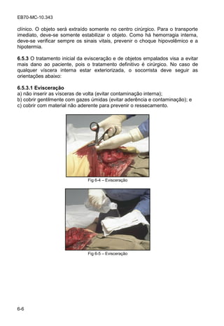 EB70-MC-10.343
6-6
clínico. O objeto será extraído somente no centro cirúrgico. Para o transporte
imediato, deve-se somente estabilizar o objeto. Como há hemorragia interna,
deve-se verificar sempre os sinais vitais, prevenir o choque hipovolêmico e a
hipotermia.
6.5.3 O tratamento inicial da evisceração e de objetos empalados visa a evitar
mais dano ao paciente, pois o tratamento definitivo é cirúrgico. No caso de
qualquer víscera interna estar exteriorizada, o socorrista deve seguir as
orientações abaixo:
6.5.3.1 Evisceração
a) não inserir as vísceras de volta (evitar contaminação interna);
b) cobrir gentilmente com gazes úmidas (evitar aderência e contaminação); e
c) cobrir com material não aderente para prevenir o ressecamento.
Fig 6-4 Evisceração
Fig 6-5 Evisceração
 
