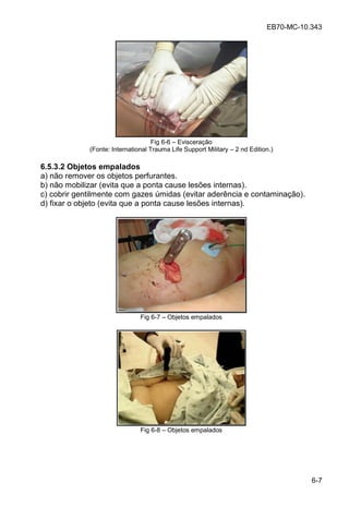 EB70-MC-10.343
6-7
Fig 6-6 Evisceração
(Fonte: International Trauma Life Support Military 2 nd Edition.)
6.5.3.2 Objetos empalados
a) não remover os objetos perfurantes.
b) não mobilizar (evita que a ponta cause lesões internas).
c) cobrir gentilmente com gazes úmidas (evitar aderência e contaminação).
d) fixar o objeto (evita que a ponta cause lesões internas).
Fig 6-7 Objetos empalados
Fig 6-8 Objetos empalados
 