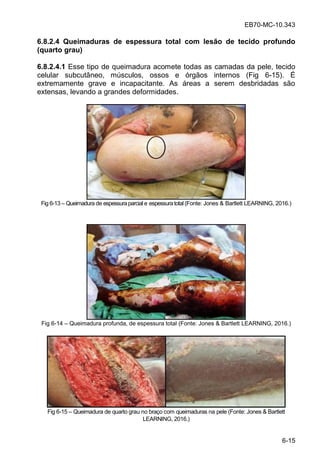 EB70-MC-10.343
6-15
6.8.2.4 Queimaduras de espessura total com lesão de tecido profundo
(quarto grau)
6.8.2.4.1 Esse tipo de queimadura acomete todas as camadas da pele, tecido
celular subcutâneo, músculos, ossos e órgãos internos (Fig 6-15). É
extremamente grave e incapacitante. As áreas a serem desbridadas são
extensas, levando a grandes deformidades.
Fig 6-13 Queimadura de espessuraparcial e espessuratotal (Fonte: Jones & Bartlett LEARNING, 2016.)
Fig 6-14 Queimadura profunda, de espessura total (Fonte: Jones & Bartlett LEARNING, 2016.)
Fig 6-15 Queimadura de quarto grau no braço com queimaduras na pele (Fonte: Jones & Bartlett
LEARNING, 2016.)
 