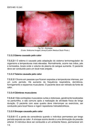 EB70-MC-10.343
7-8
Fig 7-8 Brotoejas
(Fonte: Wellcome Images Library/Custom Medical Stock Photo.)
7.3.3.2 Edema causado pelo calor
7.3.3.2.1 O edema é causado pela adaptação do sistema termorregulador do
organismo a temperaturas mais elevadas. Normalmente, ocorre nas mãos, pés
e tornozelos, locais onde o volume de plasma do sangue aumenta. O paciente
deve ser conduzido para um local mais arejado.
7.3.3.3 Tetania causada pelo calor
7.3.3.3.1 Ocorre em pessoas que ficaram expostas a temperaturas intensas, por
um curto período. Há aumento da frequência respiratória, dormência,
formigamento e espasmos musculares. O paciente deve ser retirado da fonte de
calor.
7.3.3.4 Câimbras musculares
7.3.3.4.1 São contrações musculares curtas e dolorosas, geralmente localizadas
na panturrilha, e são comuns após a realização de atividade física de longa
duração. O paciente com esse quadro deve interromper os exercícios, ser
conduzido para local fresco e ingerir repositores hidroeletrolíticos.
7.3.3.5 Síncope causada pelo calor
7.3.3.5.1 É a perda da consciência quando o indivíduo permanece por longo
período exposto ao calor. A síncope ocorre devido a uma diminuição da pressão
arterial. O indivíduo deve ser conduzido a um ambiente fresco, permanecer em
 