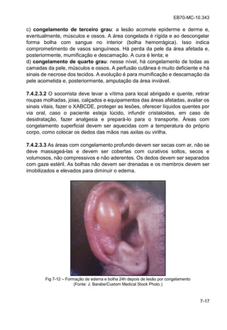 EB70-MC-10.343
7-17
c) congelamento de terceiro grau: a lesão acomete epiderme e derme e,
eventualmente, músculos e ossos. A área congelada é rígida e ao descongelar
forma bolha com sangue no interior (bolha hemorrágica). Isso indica
comprometimento de vasos sanguíneos. Há perda da pele da área afetada e,
posteriormente, mumificação e descamação. A cura é lenta; e
d) congelamento de quarto grau: nesse nível, há congelamento de todas as
camadas da pele, músculos e ossos. A perfusão cutânea é muito deficiente e há
sinais de necrose dos tecidos. A evolução é para mumificação e descamação da
pele acometida e, posteriormente, amputação da área inviável.
7.4.2.3.2 O socorrista deve levar a vítima para local abrigado e quente, retirar
roupas molhadas, joias, calçados e equipamentos das áreas afetadas, avaliar os
sinais vitais, fazer o XABCDE, proteger as lesões, oferecer líquidos quentes por
via oral, caso o paciente esteja lúcido, infundir cristaloides, em caso de
desidratação, fazer analgesia e prepará-lo para o transporte. Áreas com
congelamento superficial devem ser aquecidas com a temperatura do próprio
corpo, como colocar os dedos das mãos nas axilas ou virilha.
7.4.2.3.3 As áreas com congelamento profundo devem ser secas com ar, não se
deve massageá-las e devem ser cobertas com curativos soltos, secos e
volumosos, não compressivos e não aderentes. Os dedos devem ser separados
com gaze estéril. As bolhas não devem ser drenadas e os membros devem ser
imobilizados e elevados para diminuir o edema.
Fig 7-12 Formação de edema e bolha 24h depois de lesão por congelamento
(Fonte: J. Barabe/Custom Medical Stock Photo.)
 