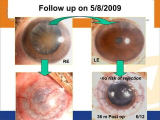 Follow up on 5/8/2009
RE LE
6/1236 m Post op
•no risk of rejection
 