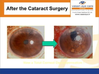 After the Cataract Surgery
Now a Total Corneal Decompensation !
 