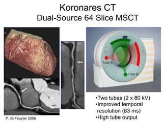 Koronares CT
Dual-Source 64 Slice MSCT

P. de Feuyter 2006

• Two tubes (2 x 80 kV)
• Improved temporal
resolution (83 ms)
• High tube output

 