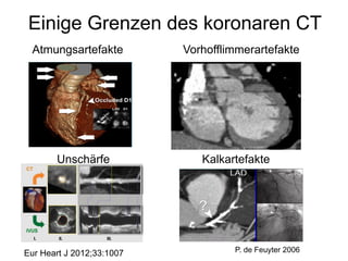 Einige Grenzen des koronaren CT
Atmungsartefakte

Unschärfe

Eur Heart J 2012;33:1007

Vorhofflimmerartefakte

Kalkartefakte

P. de Feuyter 2006

 