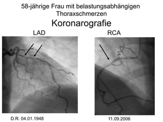 58-jährige Frau mit belastungsabhängigen
Thoraxschmerzen

Koronarografie
LAD

D.R. 04.01.1948

RCA

11.09.2006

 