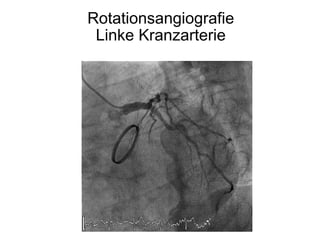 Rotationsangiografie
Linke Kranzarterie

 