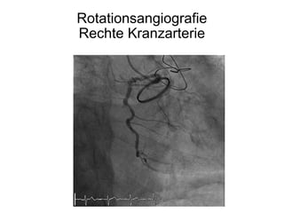 Rotationsangiografie
Rechte Kranzarterie

 