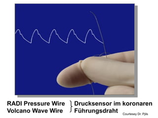 RADI Pressure Wire
Volcano Wave Wire

Drucksensor im koronaren
Führungsdraht Courtesey Dr. Pjils

 