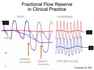 Fractional Flow Reserve
in Clinical Practice
REST

HYPEREMIA

150

112
100

58
50
Crossing
the lesion
0

Distal to
the lesion

FFR=58/112=0.52
Courtesey Dr. Pjils

 