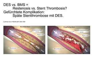 DES vs. BMS =
Restenosis vs. Stent Thrombosis?
Gefürchtete Komplikation:
Späte Stentthrombose mit DES.
Curfman et al. NEJM 2007;356:1059

 
