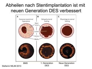 Abheilen nach Stentimplantation ist mit
neuen Generation DES verbessert

BMS
Stefanini NEJM 2013

1. Generation
DES

Neue Generation
DES

 