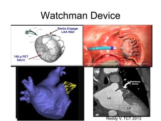 Watchman Device

Reddy V. TCT 2013

 