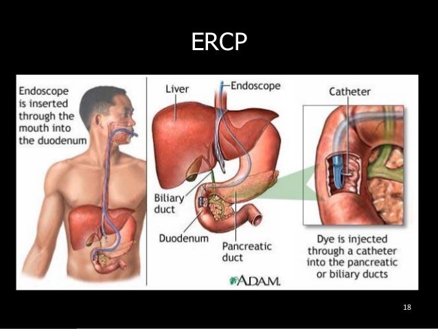 Stones Removed From Bile Duct – Causes of bile duct cancer – PRLCE