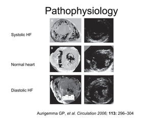 Aurigemma GP, et al. Circulation 2006; 113: 296–304
Systolic HF
Normal heart
Diastolic HF
Pathophysiology
 