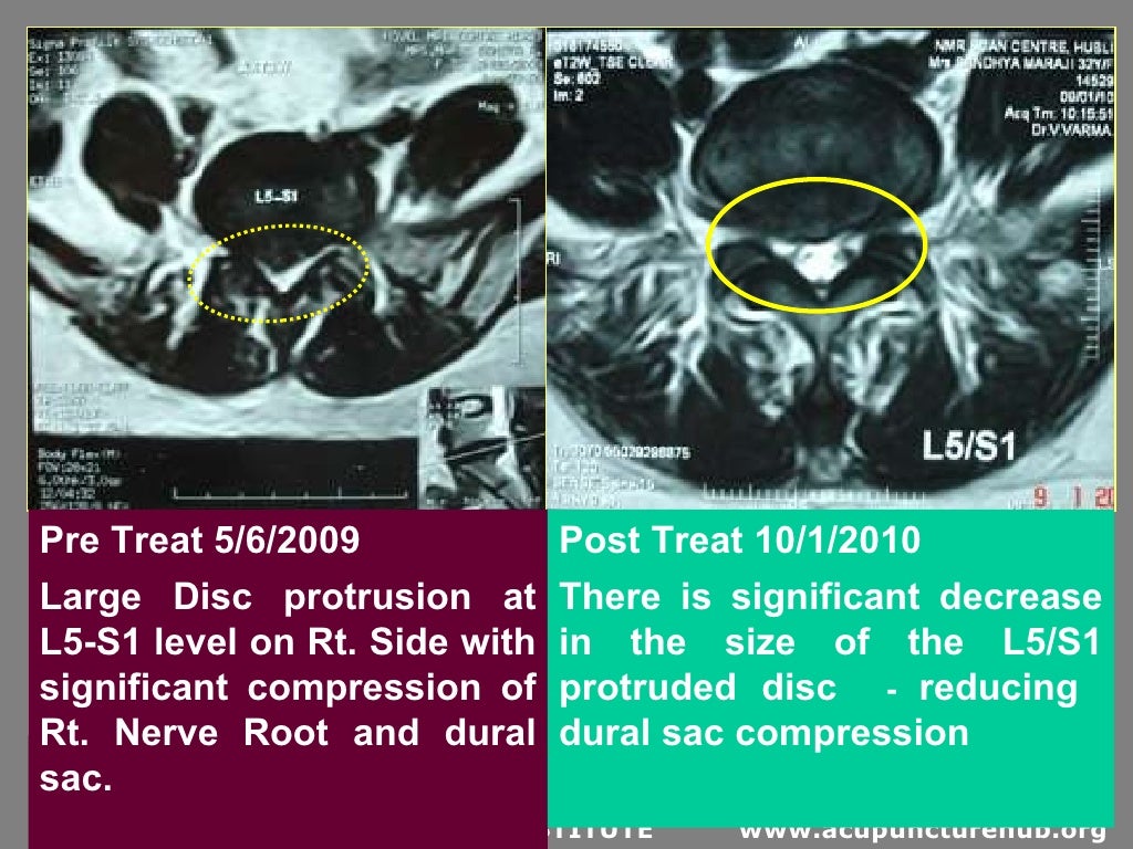 acupuncture for Lumbar disk herniation