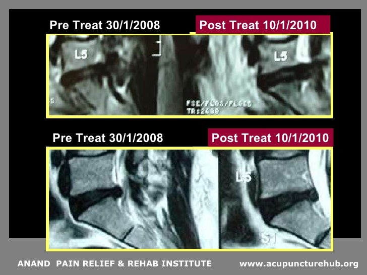 acupuncture for Lumbar disk herniation