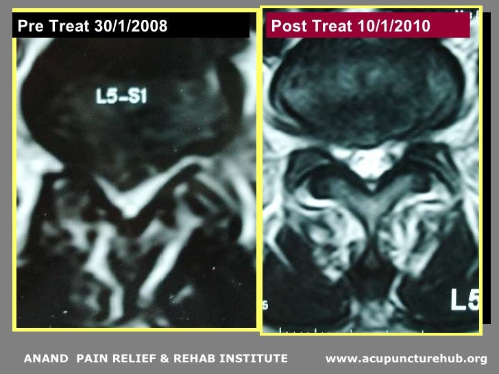 acupuncture for Lumbar disk herniation
