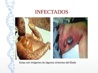 INFECTADOS 
Estas son imágenes de algunos síntomas del Ébola 
 