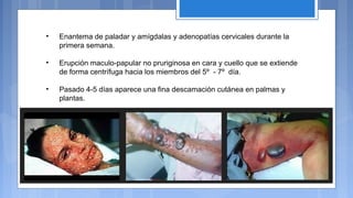 • Enantema de paladar y amígdalas y adenopatías cervicales durante la
primera semana.
• Erupción maculo-papular no pruriginosa en cara y cuello que se extiende
de forma centrífuga hacia los miembros del 5º - 7º día.
• Pasado 4-5 días aparece una fina descamación cutánea en palmas y
plantas.
 