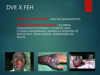 DVE X FEH
DOENÇA DO VIRUS EBOLA – NÃO HÁ SANGRAMENTOS
FEBRE HEMORRAGICA DO EBOLA – OCORREM
SANGRAMENTOS INTERNOS E EXTERNOS, RASH
CUTÂNEO HEMORRÁGICO, AUMENTA A SENSAÇÃO DE
DOR NA PELE, EDEMA GENITAL, VERMELHIDÃO NO
PALATO
 